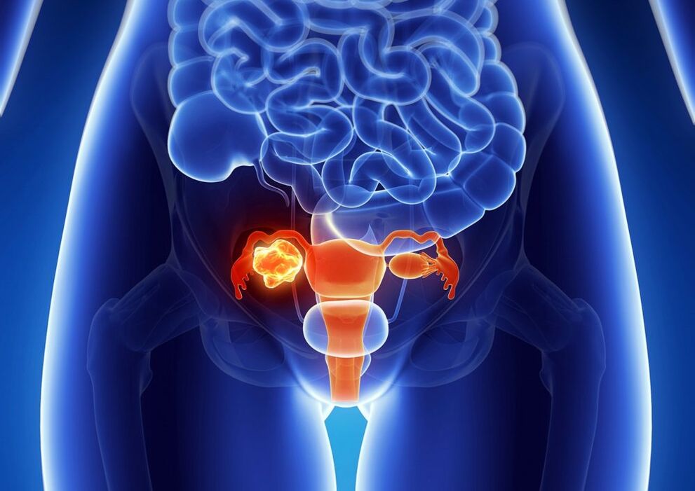 Ovary pathology of women under the influence of alcohol